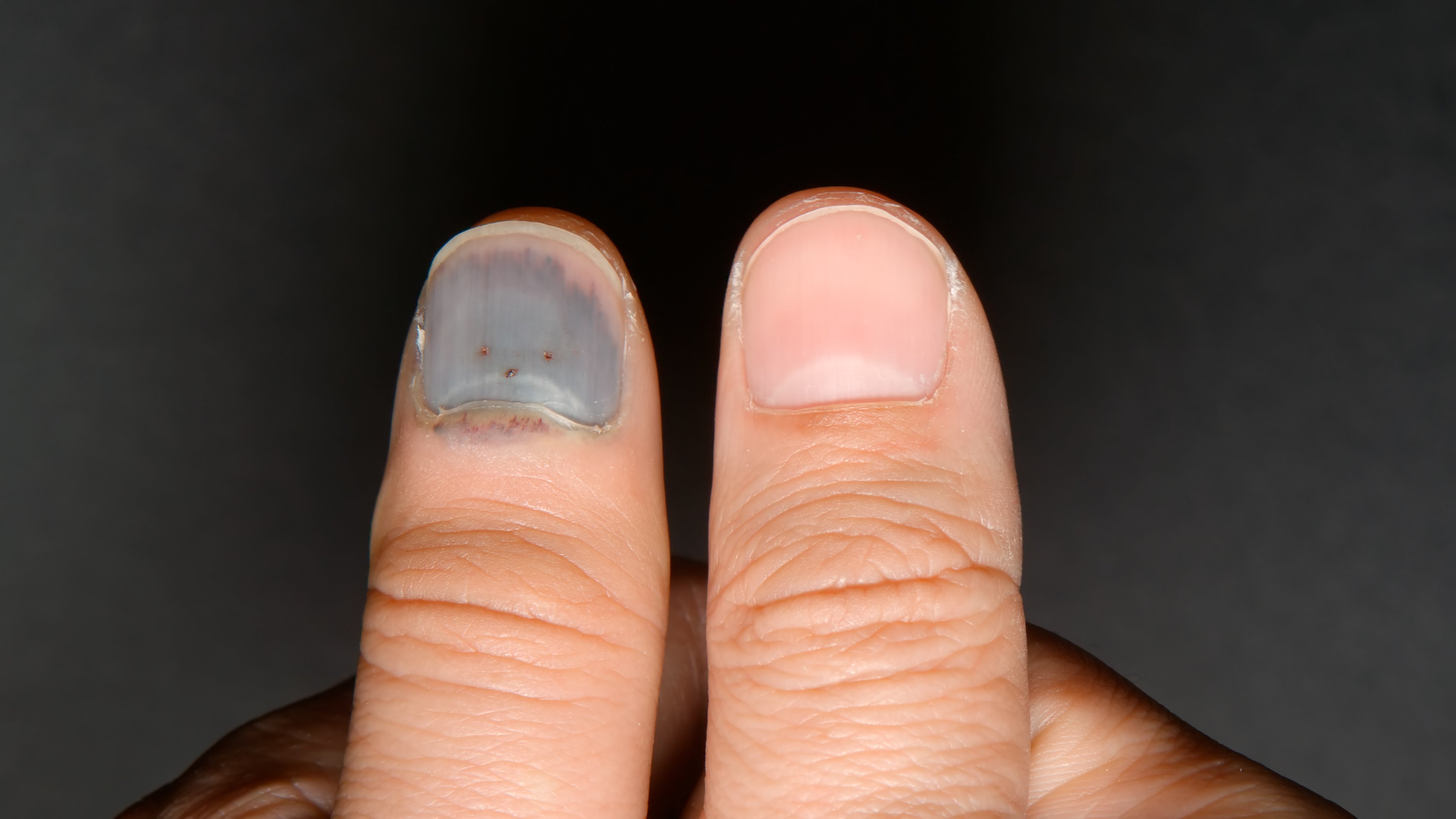 Close-up showing a bruised fingernail contrasted with a healthy nail