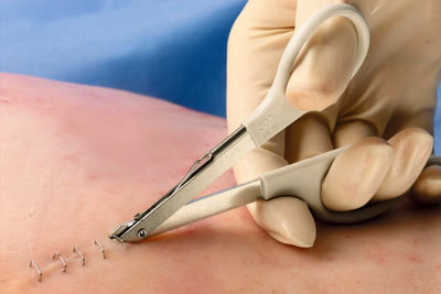 How to Use a Staple Removal Kit for Safe Staple Removal Prepared