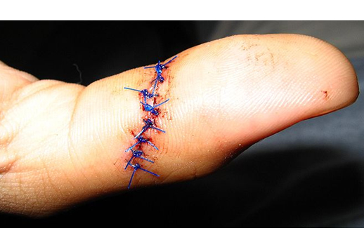 Essential Steps in Laceration Repair