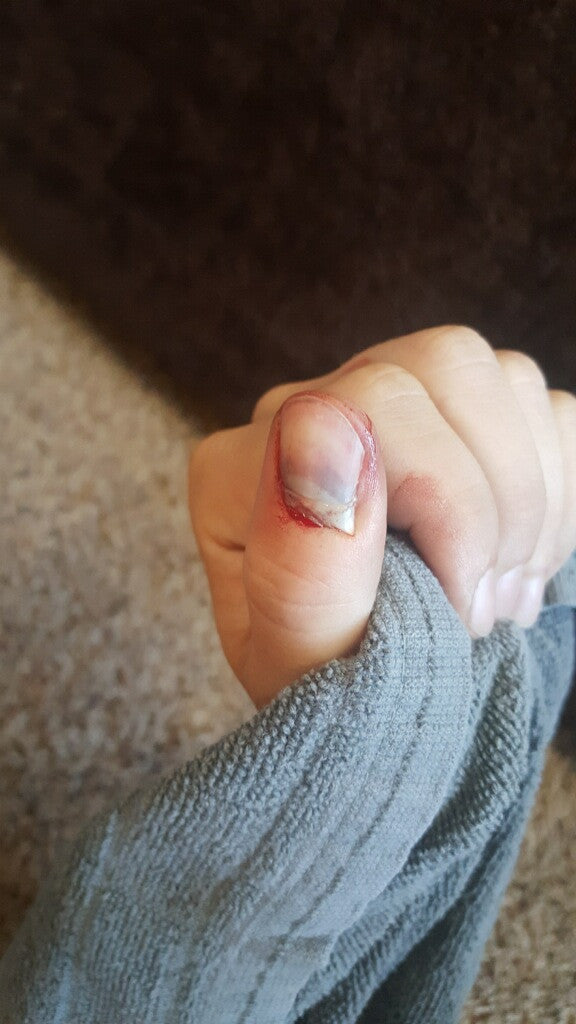 Partial Thumb Nail Avulsion