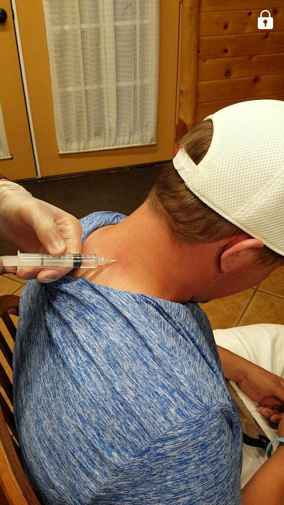 Left Paraspinal Injection Versatility of Provider Prepared Kits – Prepared Physician